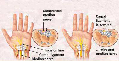 schema of carpal tunnel release